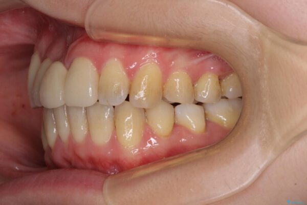 転んで前歯が欠けた　折れた前歯をきっかけに矯正治療で歯列をきれいに整える 治療後画像