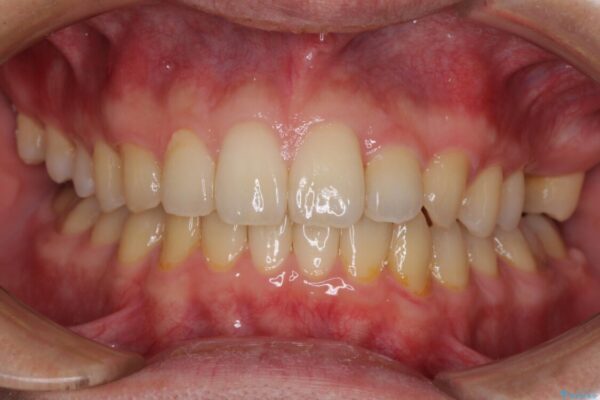 前歯のクロスバイトと抜歯が必要な奥歯の虫歯　インビザラインとインプラント治療 治療途中画像