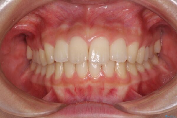 就職前にきれいな歯並びにしたい　大学生のインビザライン矯正 治療途中画像