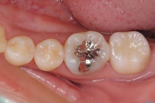 奥歯が痛い　保険治療後に症状が発現した歯のむし歯治療 治療後画像