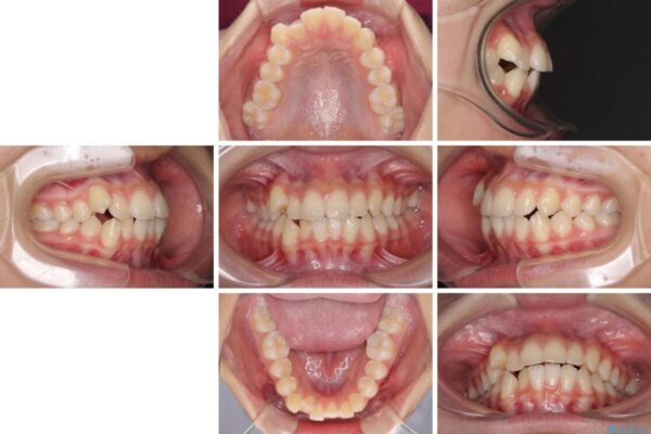 気がつくと口が開いてしまう　閉じにくい口元改善の抜歯矯正 治療前画像
