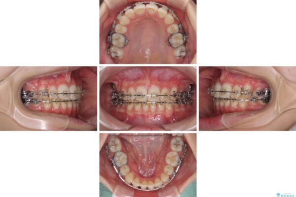 治療途中で転院　抜歯矯正の仕上げ治療 治療途中画像