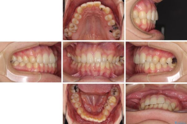 前歯のクロスバイトと抜歯が必要な奥歯の虫歯　インビザラインとインプラント治療 治療前画像