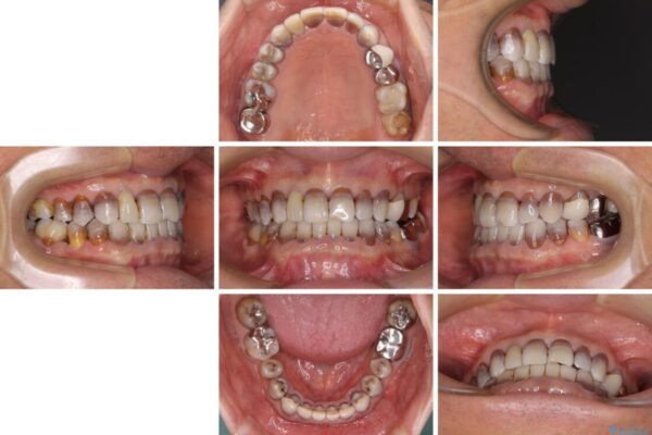 下の歯が前に出てしまう咬み合わせを治したい　インビザラインによる矯正治療 治療後画像