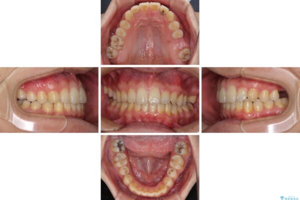 前歯のクロスバイトと抜歯が必要な奥歯の虫歯　インビザラインとインプラント治療 治療途中画像