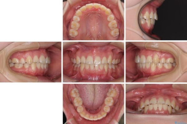 前歯が磨きにくい　目立たないワイヤー装置による矯正治療 治療後画像