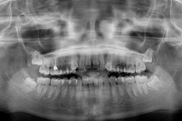 気がつくと口が開いてしまう　閉じにくい口元改善の抜歯矯正 治療前画像