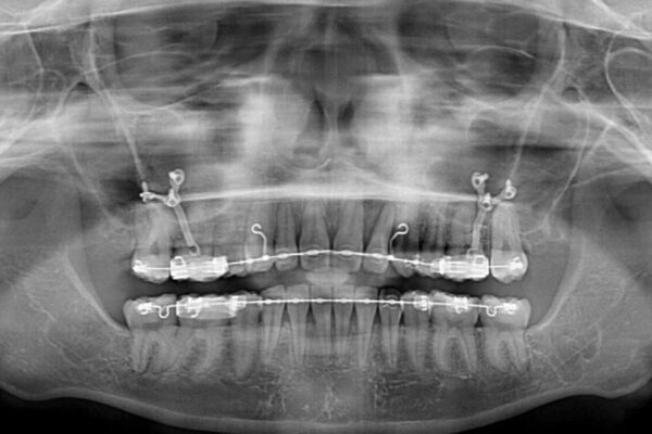 治療途中で転院　抜歯矯正の仕上げ治療 治療前画像