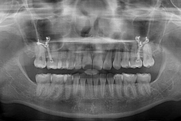 治療途中で転院　抜歯矯正の仕上げ治療 治療後画像