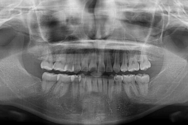 前歯が磨きにくい　目立たないワイヤー装置による矯正治療 治療後画像