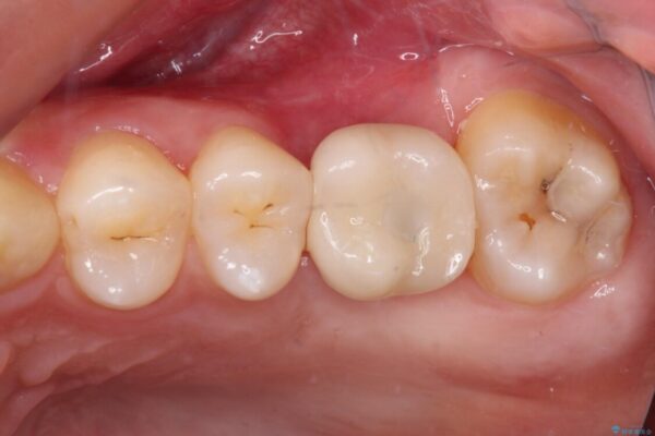 前歯のクロスバイトと抜歯が必要な奥歯の虫歯　インビザラインとインプラント治療 治療後画像