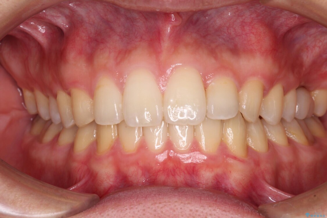 前歯のクロスバイトと抜歯が必要な奥歯の虫歯　インビザラインとインプラント治療 アフター