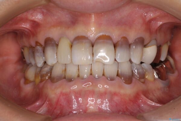 下の歯が前に出てしまう咬み合わせを治したい　インビザラインによる矯正治療 アフター