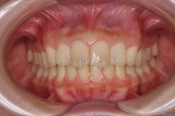 就職前にきれいな歯並びにしたい　大学生のインビザライン矯正 治療後画像