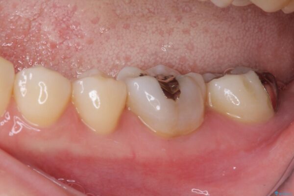 奥歯が痛い　保険治療後に症状が発現した歯のむし歯治療 治療前画像