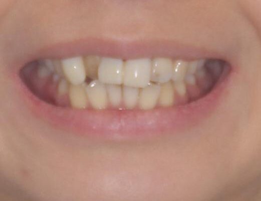 転んで前歯が欠けた　折れた前歯をきっかけに矯正治療で歯列をきれいに整える 治療前画像