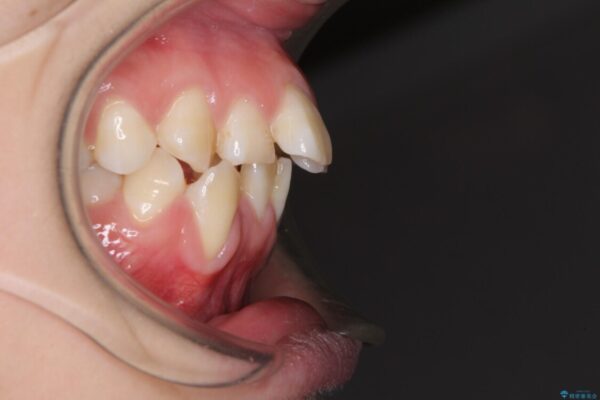 前歯が磨きにくい　目立たないワイヤー装置による矯正治療 治療前画像