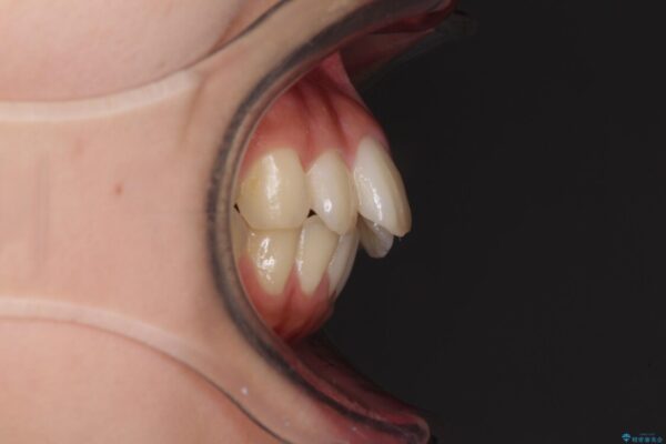 就職前にきれいな歯並びにしたい　大学生のインビザライン矯正 治療前画像