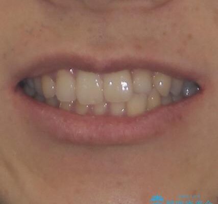前歯のクロスバイトと抜歯が必要な奥歯の虫歯　インビザラインとインプラント治療 治療前画像