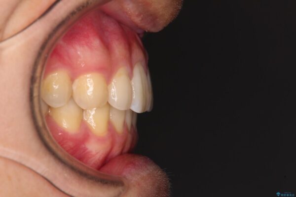 前歯のクロスバイトと抜歯が必要な奥歯の虫歯　インビザラインとインプラント治療 治療後画像