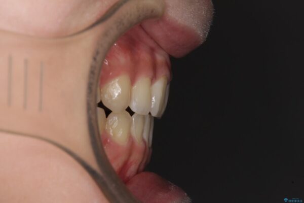 話しにくいオープンバイト　ワイヤー装置による抜歯矯正治療 治療後画像