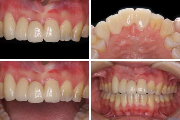 転んで前歯が欠けた　折れた前歯をきっかけに矯正治療で歯列をきれいに整える 治療後画像