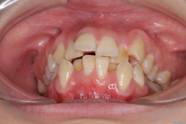 前歯が磨きにくい　目立たないワイヤー装置による矯正治療 治療前画像