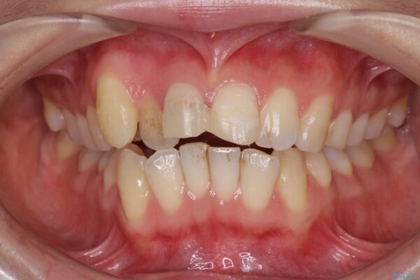 転んで前歯が欠けた　折れた前歯をきっかけに矯正治療で歯列をきれいに整える 治療前画像