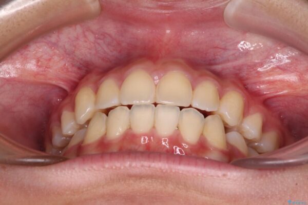 気がつくと口が開いてしまう　閉じにくい口元改善の抜歯矯正 治療後画像