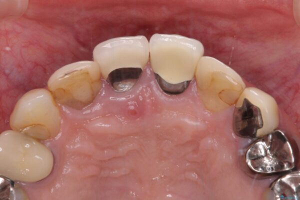 鼻の下を押すと痛い　抜歯を避けてきた歯を抜歯して自然な口元に 治療前画像