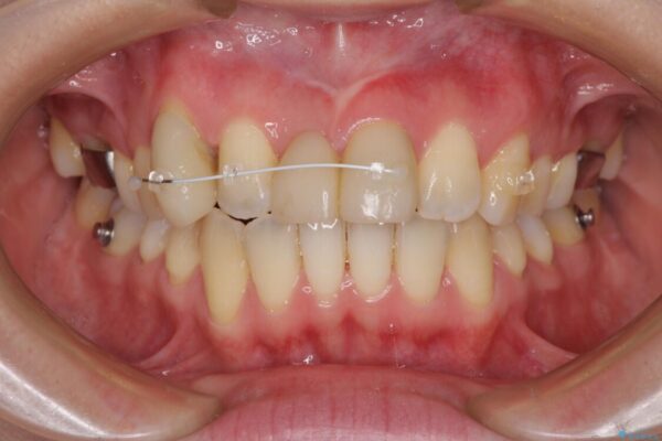 転んで前歯が欠けた　折れた前歯をきっかけに矯正治療で歯列をきれいに整える 治療途中画像