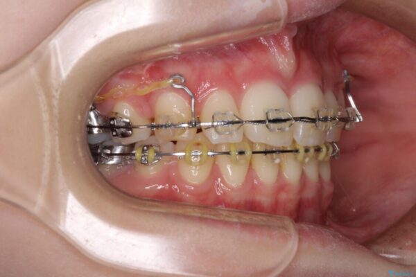 治療途中で転院　抜歯矯正の仕上げ治療 治療前画像