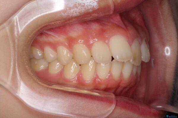 就職前にきれいな歯並びにしたい　大学生のインビザライン矯正 治療前画像