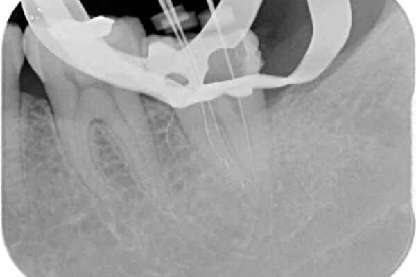 奥歯が痛い　保険治療後に症状が発現した歯のむし歯治療 治療途中画像