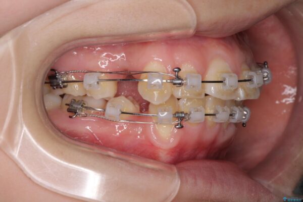前歯が磨きにくい　目立たないワイヤー装置による矯正治療 治療途中画像