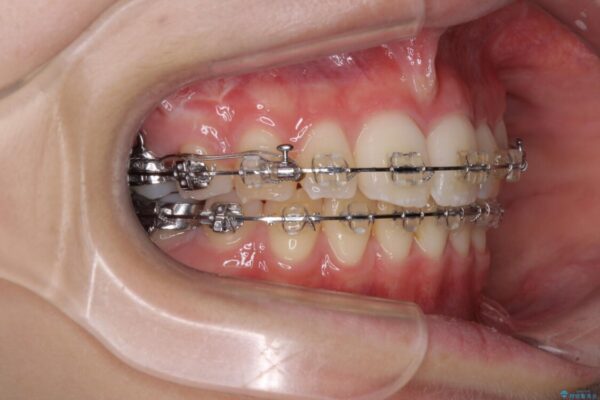 治療途中で転院　抜歯矯正の仕上げ治療 治療途中画像