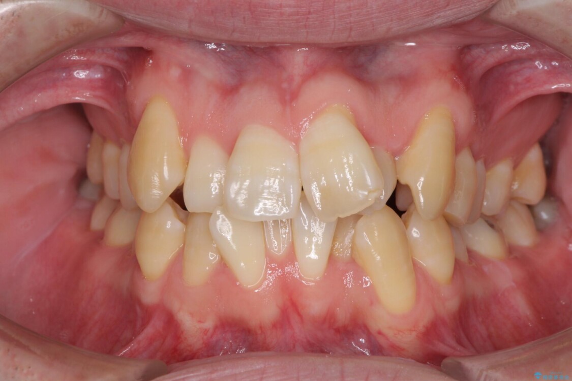 ものが挟まる　著しい叢生を解消　ワイヤー装置による抜歯矯正 治療前
