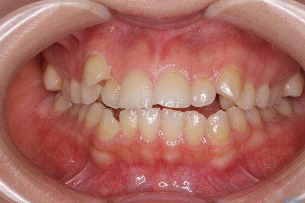 目立ちにくい抜歯矯正　ハーフリンガル 治療前画像