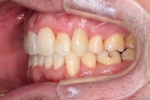 ものが挟まる　著しい叢生を解消　ワイヤー装置による抜歯矯正 治療後画像