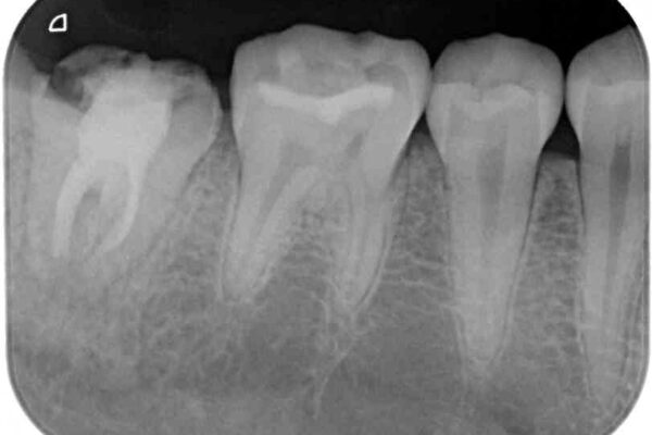 クラウンがすぐに外れてしまう　歯冠長延長術を用いた補綴治療 治療前画像