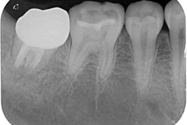 クラウンがすぐに外れてしまう　歯冠長延長術を用いた補綴治療 治療後画像