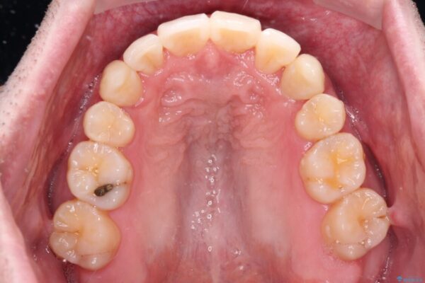 ものが挟まる　著しい叢生を解消　ワイヤー装置による抜歯矯正 治療後画像