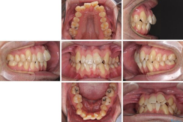 ものが挟まる　著しい叢生を解消　ワイヤー装置による抜歯矯正 治療前画像