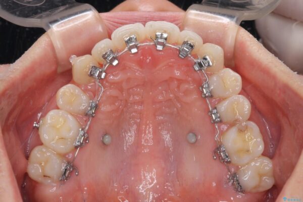 目立ちにくい抜歯矯正　ハーフリンガル 治療途中画像