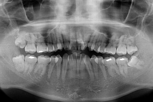 ものが挟まる　著しい叢生を解消　ワイヤー装置による抜歯矯正 治療前画像