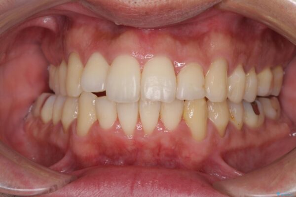 下顎骨が顕著に右側にずれている　インビザラインによる咬合改善 治療途中画像