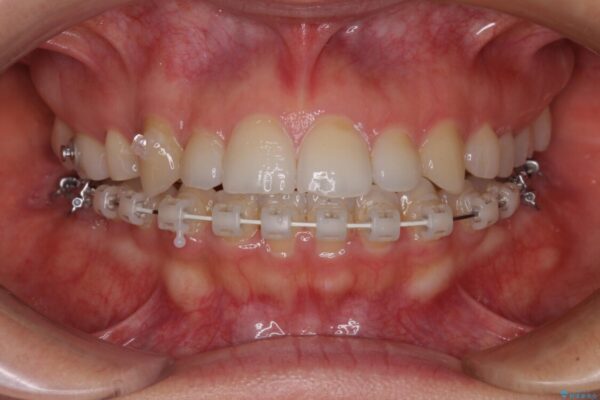 目立ちにくい抜歯矯正　ハーフリンガル 治療途中画像
