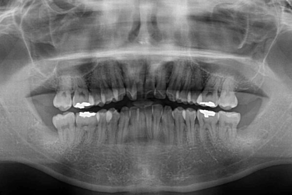 下顎骨が顕著に右側にずれている　インビザラインによる咬合改善 治療前画像