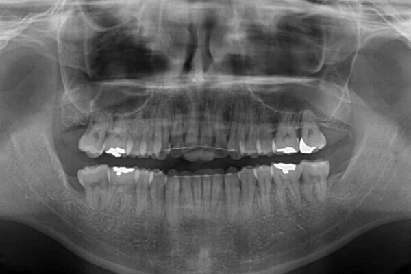 下顎骨が顕著に右側にずれている　インビザラインによる咬合改善 治療後画像