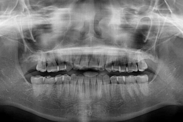 目立ちにくい抜歯矯正　ハーフリンガル 治療後画像